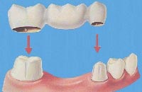 Фиксированные зубные протезы